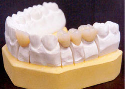 dentadura2 Tipos de Dentaduras